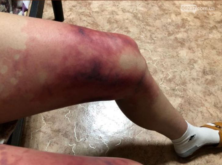В мини-юбке при -35: девушка обморозила ноги до красноты, фото-2