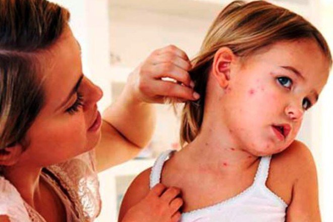 Вспышка кори в Украине. Как не заболеть (ИНФОГРАФИКА)